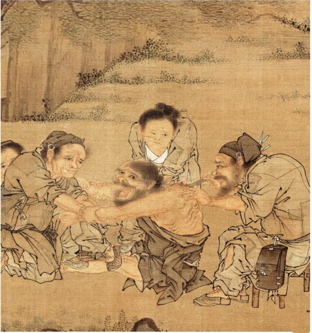 YUANWELLNESS: Custom Moxibustion Painting, Ancient Artwork Illustrating the Performance of Moxibustion, Artwork of TCM, for Clinic Wall Art - YUAN WELLNESS 